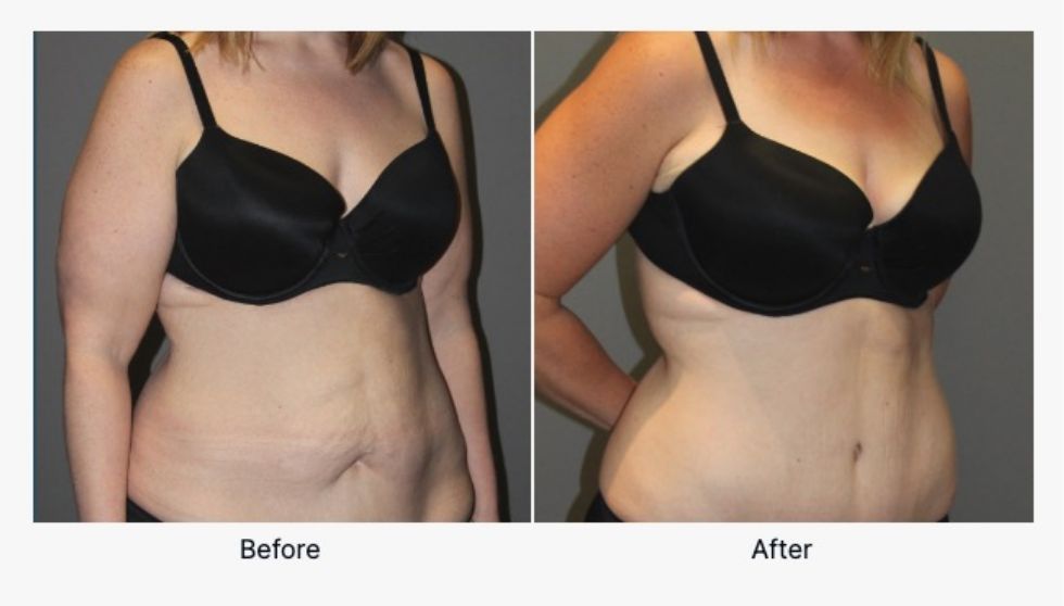 Before and After Tummy Tuck 8