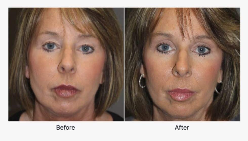 Before and After Upper Face