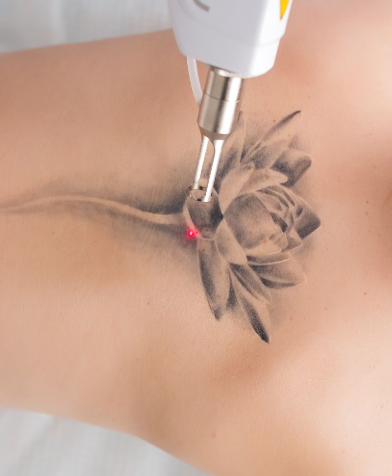 Laser Tattoo Removal in Eugene - PicoSure® | Dr. Lee B. Daniel